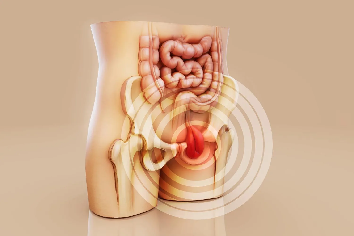 Cirugía de hernia inguinal: abierta y laparoscópica